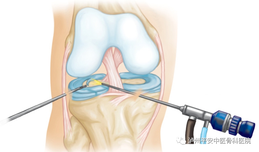 半月板損傷疼痛 關(guān)節(jié)鏡一朝解除